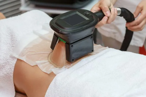 Image of person having fat freezing treatment to help weight gain Clydebank