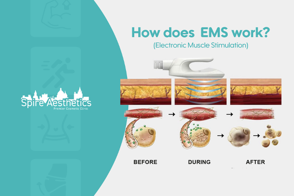 EMS treatment for post pregnancy weight loss treatment Clydebank