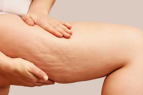 Image of woman showing leg with cellulite Clydebank