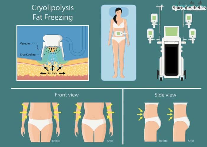 Image of diet and fat freezing combined for best results for Spire Aesthetics Clydebank