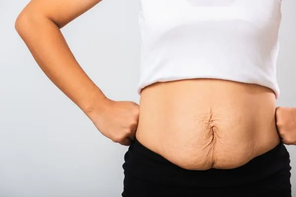 Image of a woman's stomach after weight loss with sagging skin following a gastric band Clydebank