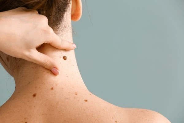 skin blemish removal Clydebank treatment