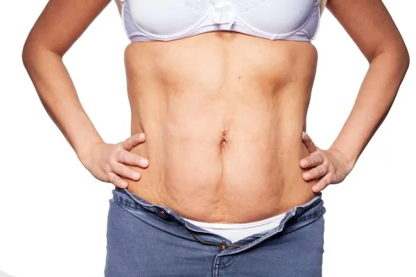 sagging skin on woman's stomach after weight loss injections Clydebank