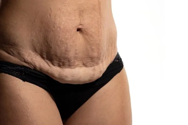 Image of womans stomach after weight loss injections Clydebank showing saggy skin