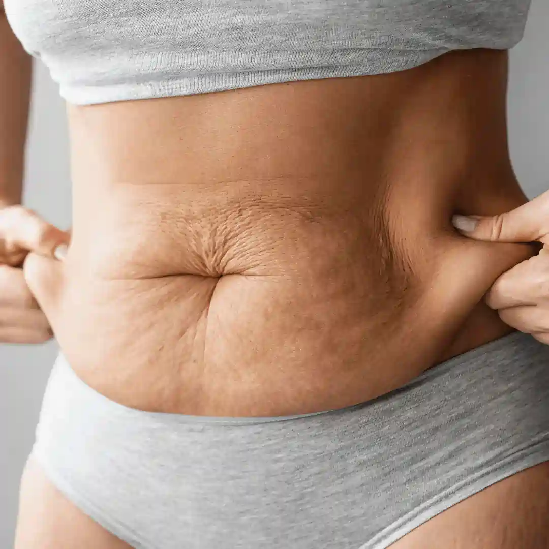 Is It Normal to Have Loose Skin After Pregnancy Clydebank?